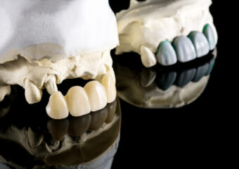 Corone e ponti dentali